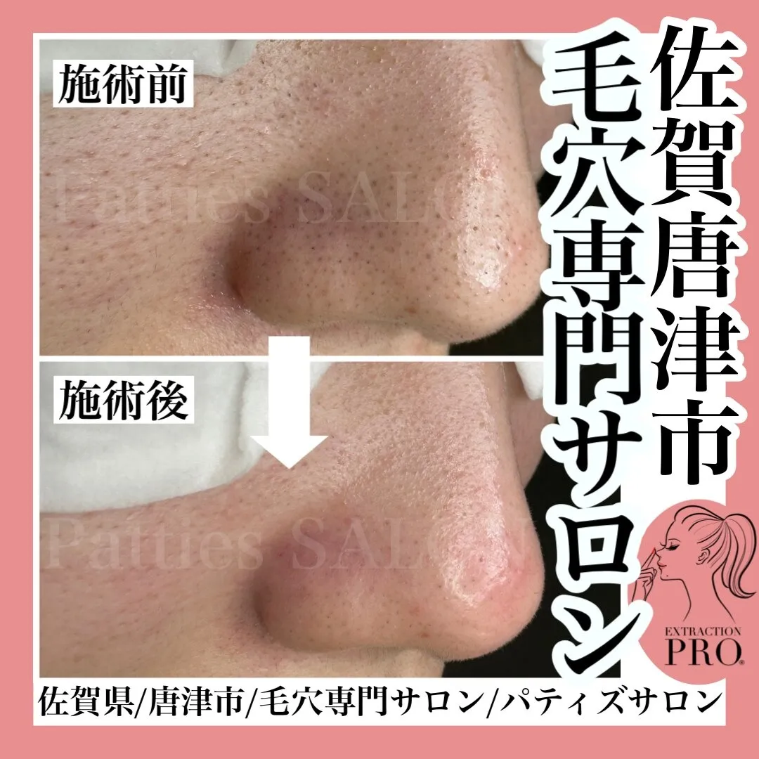 毛穴の悩みお任せください!!