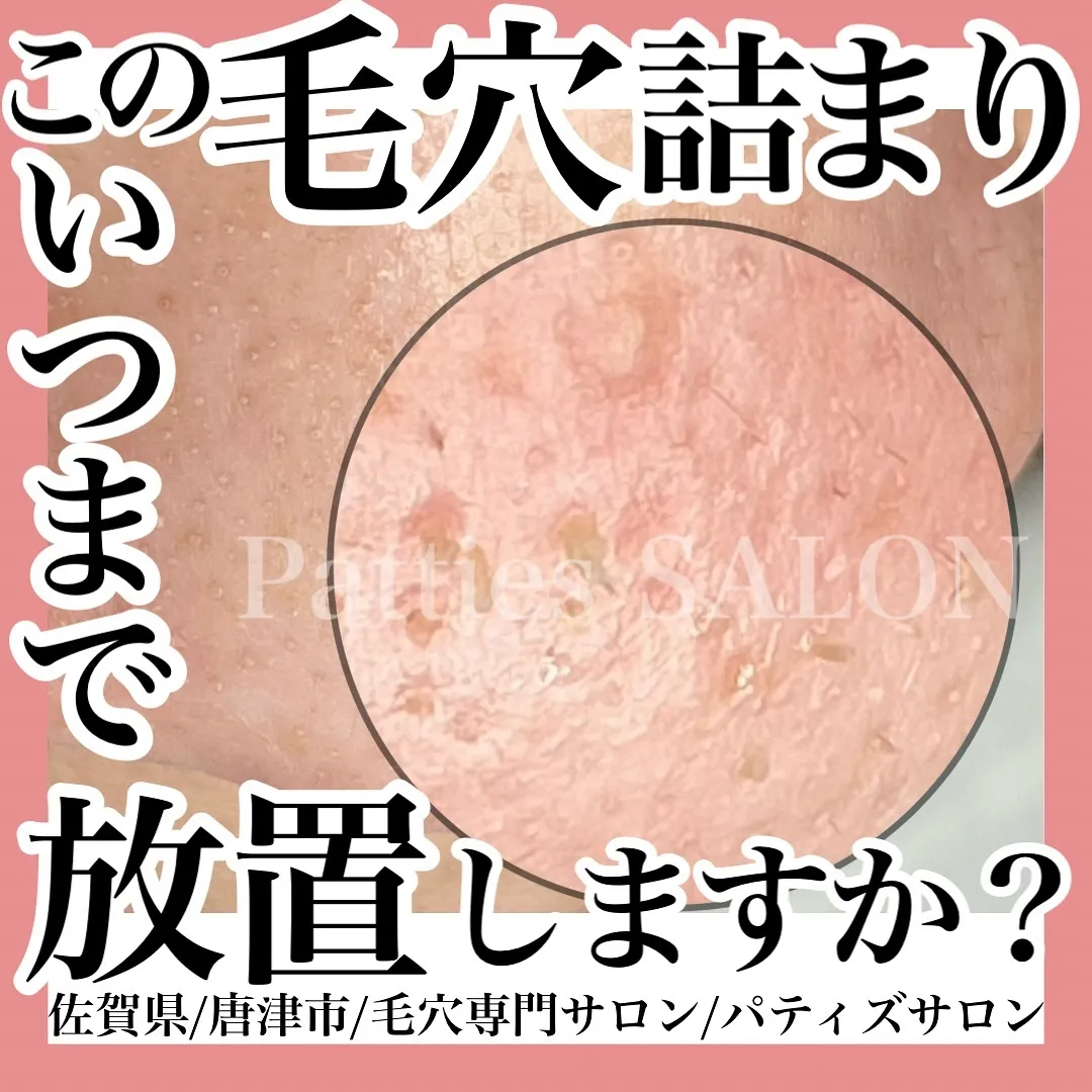 夏の通常の2倍の皮脂!