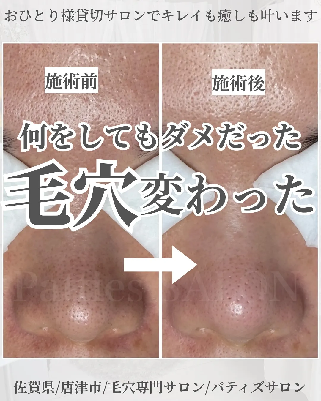 何をしてもダメだった毛穴変わった‼︎