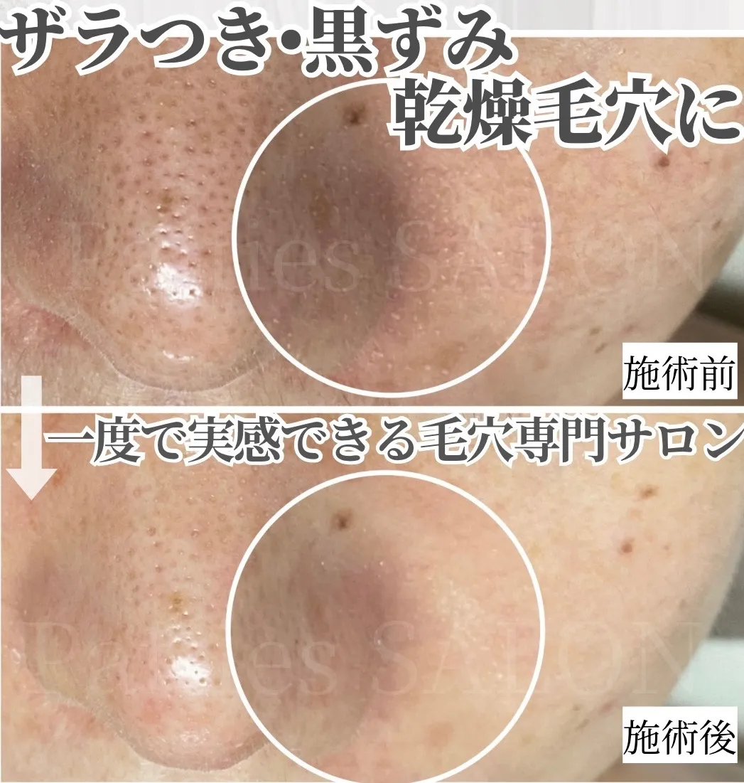 ザラつき、黒ずみ、乾燥毛穴に